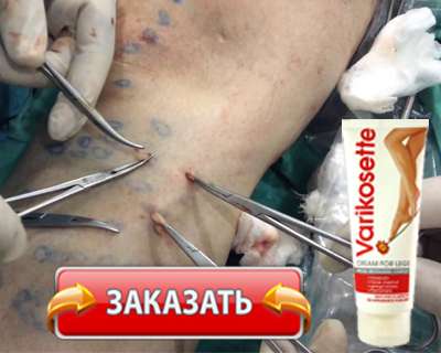 Крем Varikosette купить по доступной цене.