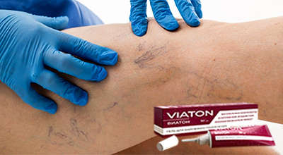 viaton-ot-varikoza